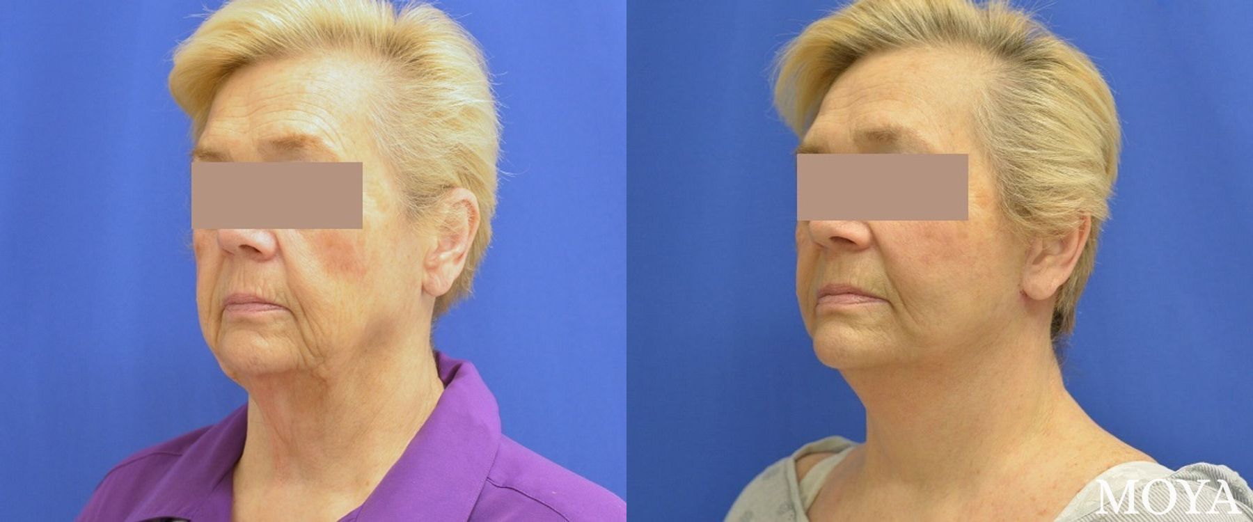 Before and after Facelift case 39136