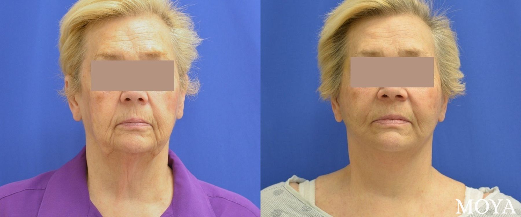 Before and after Facelift case 39136 - Angle 2