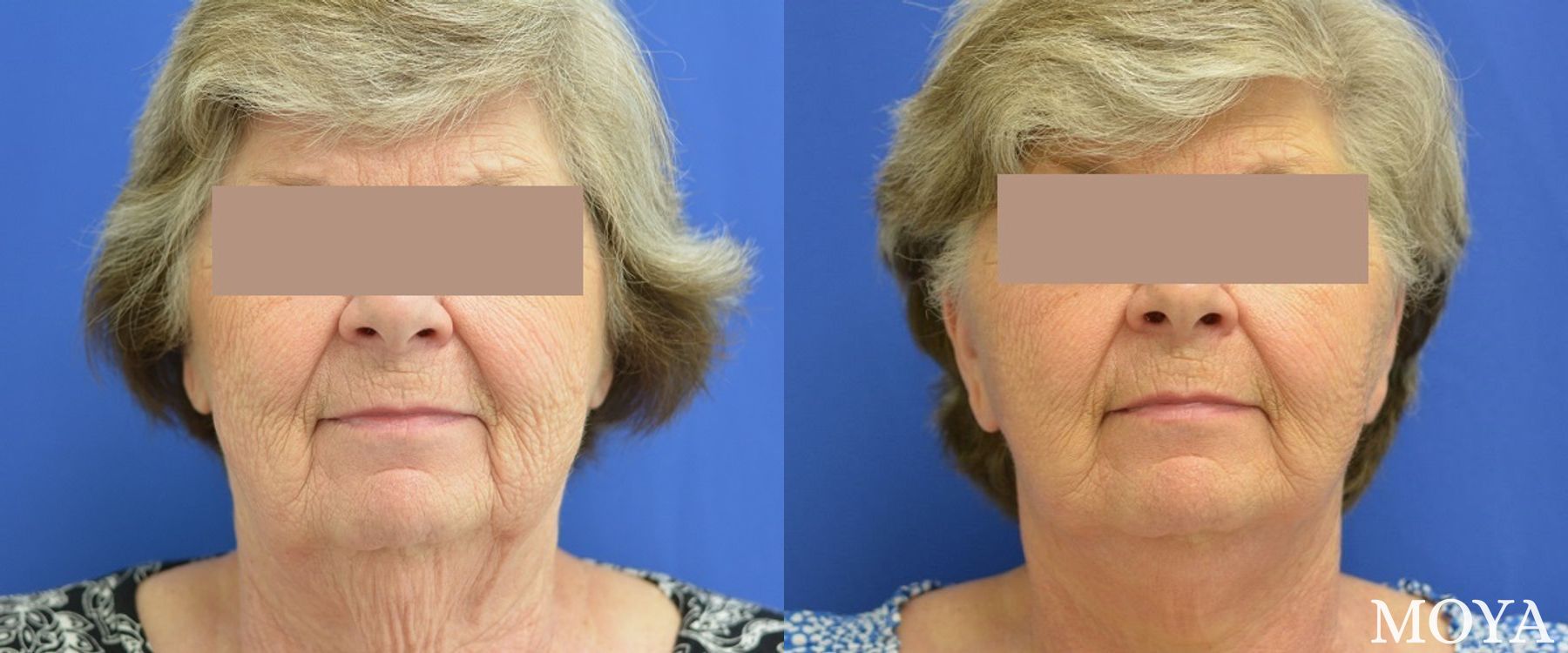Before and after Facelift case 39161 - Angle 2