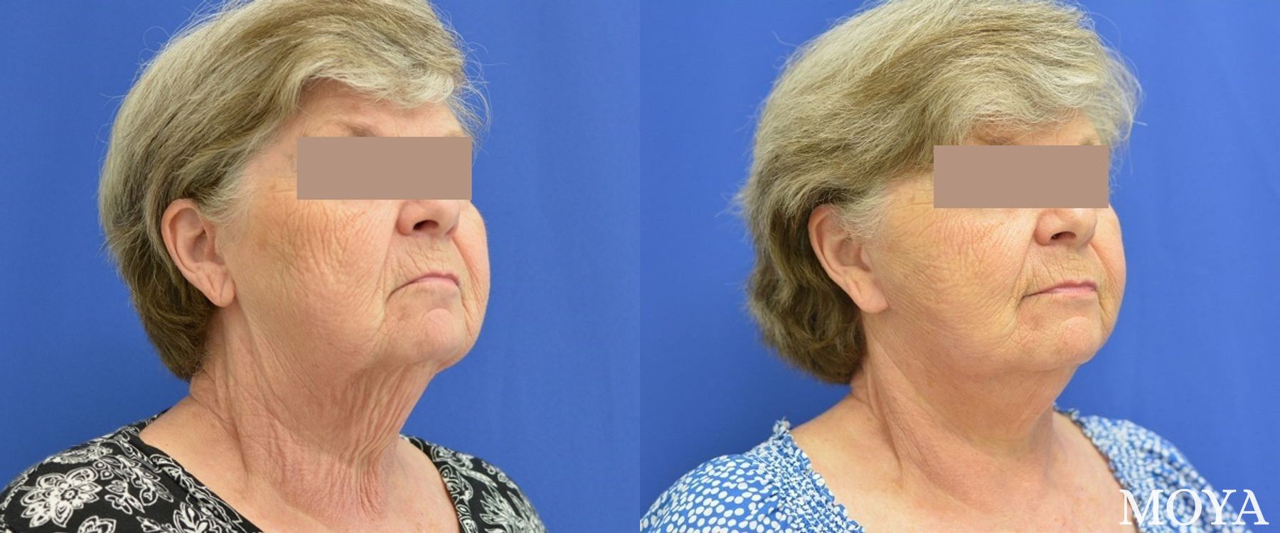 Before and after Facelift case 39161