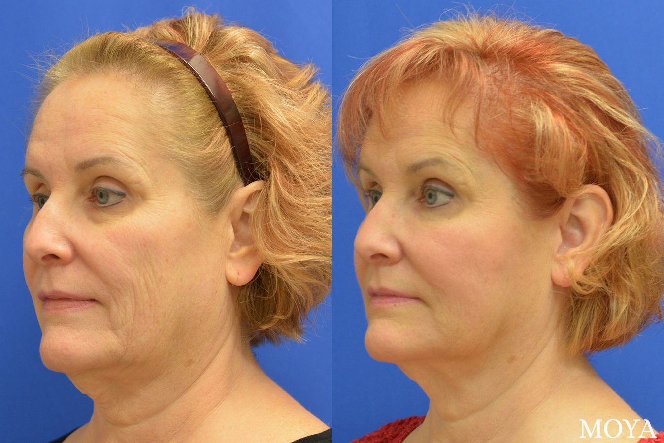 Before and after Fillers case 39203 - Angle 2