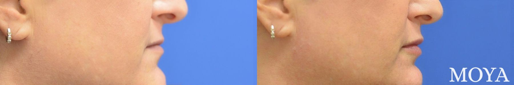 Before and after Fillers case 39093 - Angle 2