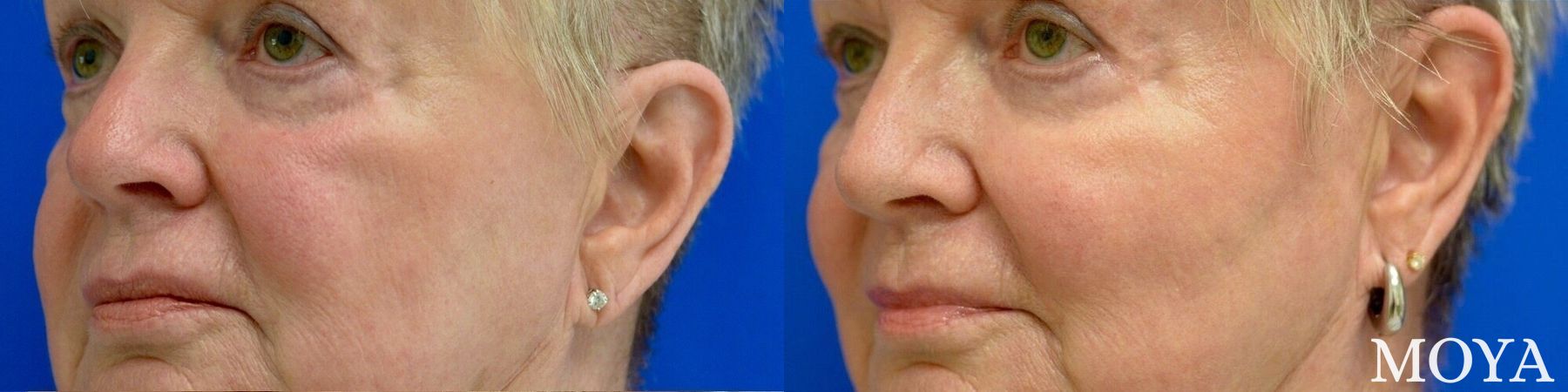 Before and after Fillers case 39165 - Angle 2