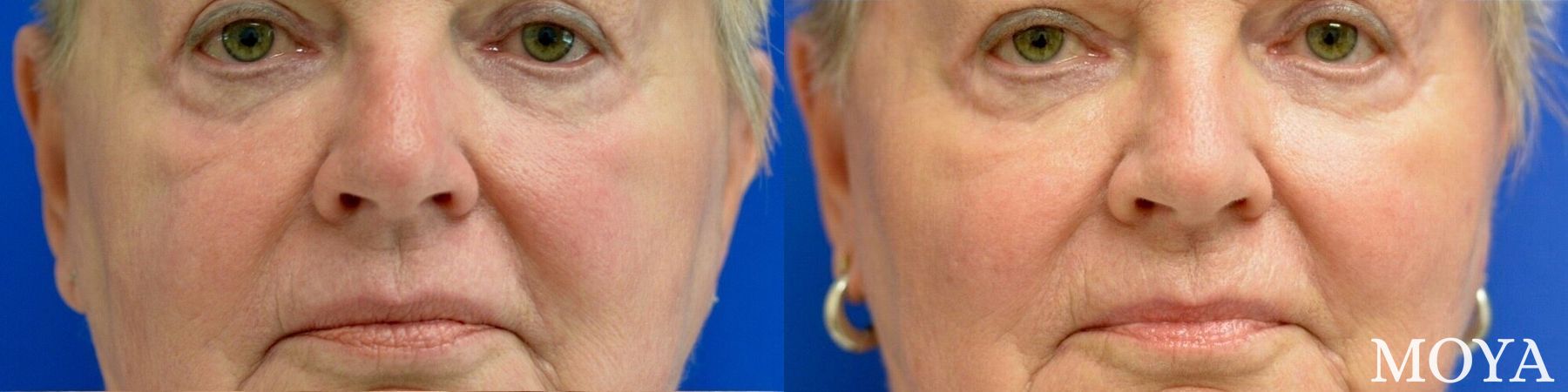 Before and after Fillers case 39165