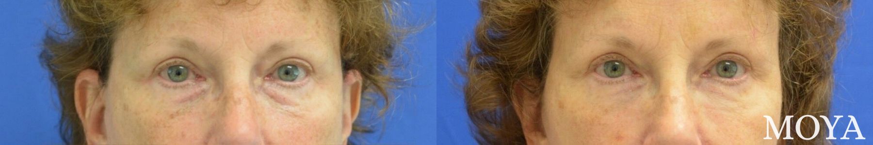 Before and after Fillers case 39147