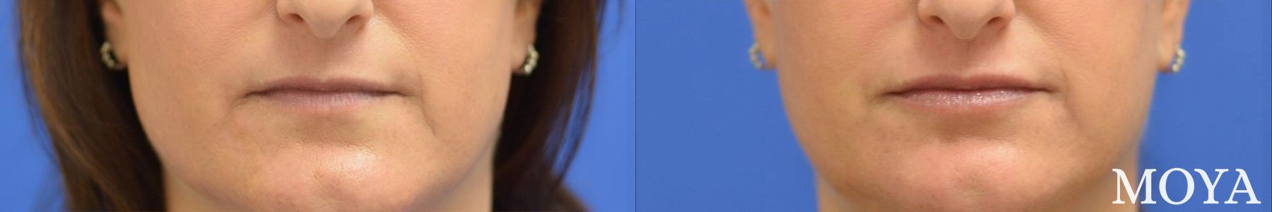 Before and after Fillers case 39093