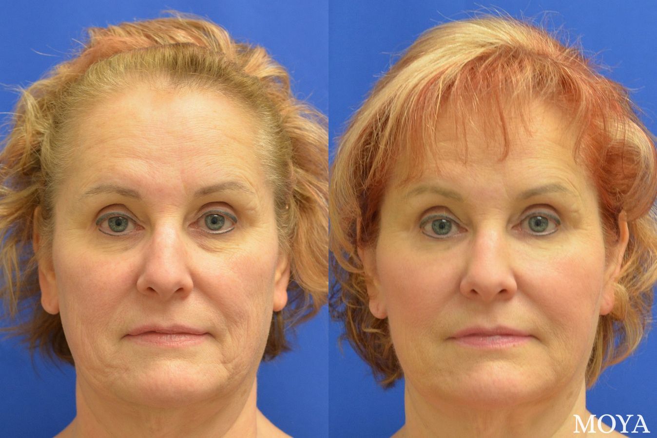 Before and after Fillers case 39203