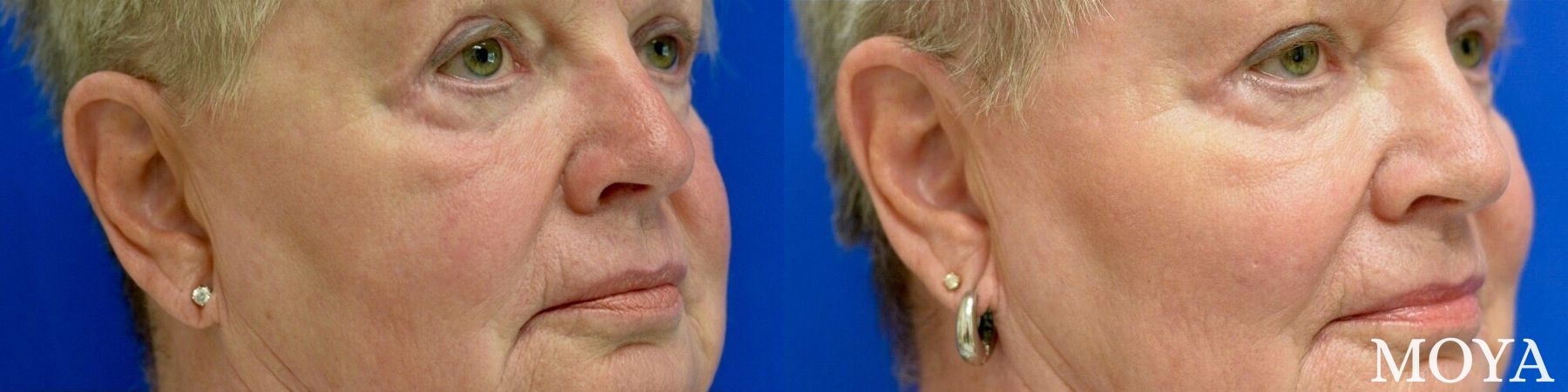 Before and after Fillers case 39165 - Angle 3