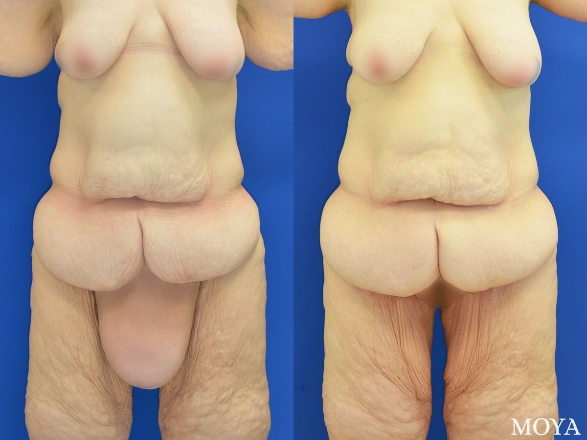 Before and after Mons Pubis Reduction case 39077
