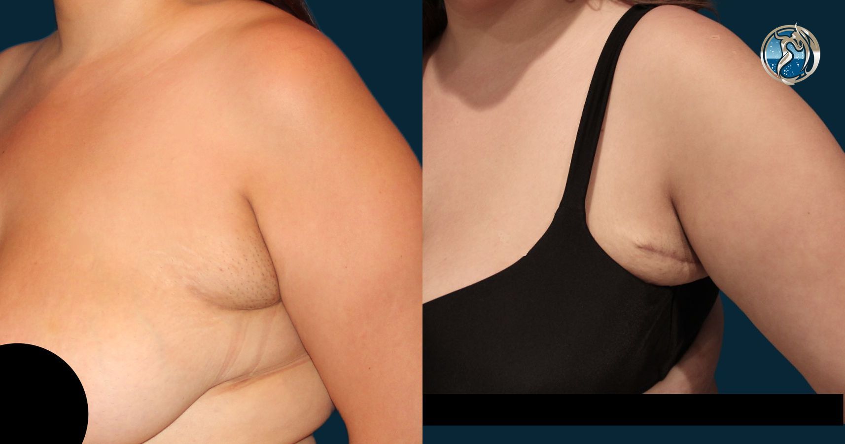 Before and after photo set of Accessory Axillary Breast Tissue Excision by Dr. Orna Fisher in San Mateo, CA