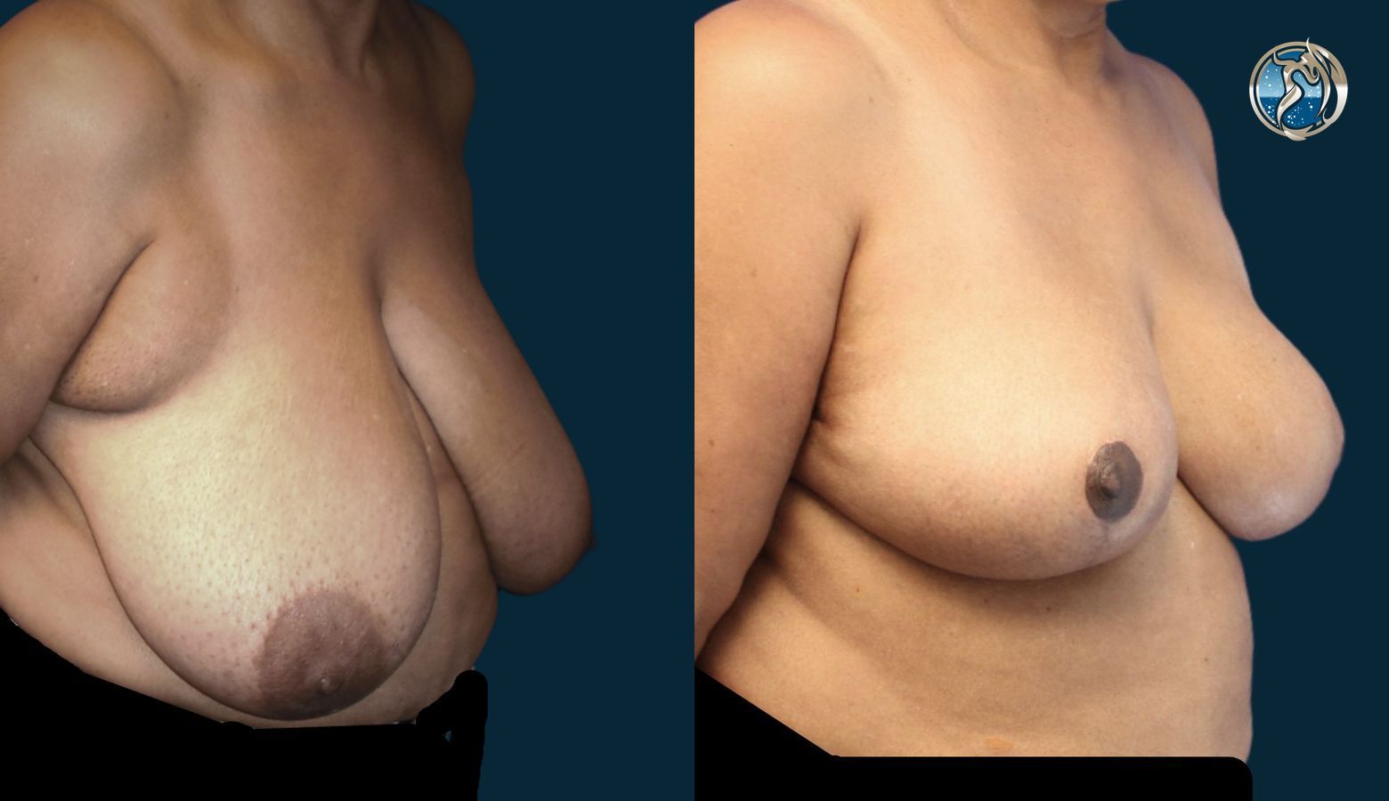 Before and after photo set of Breast Reduction by Dr. Orna Fisher in San Mateo, CA