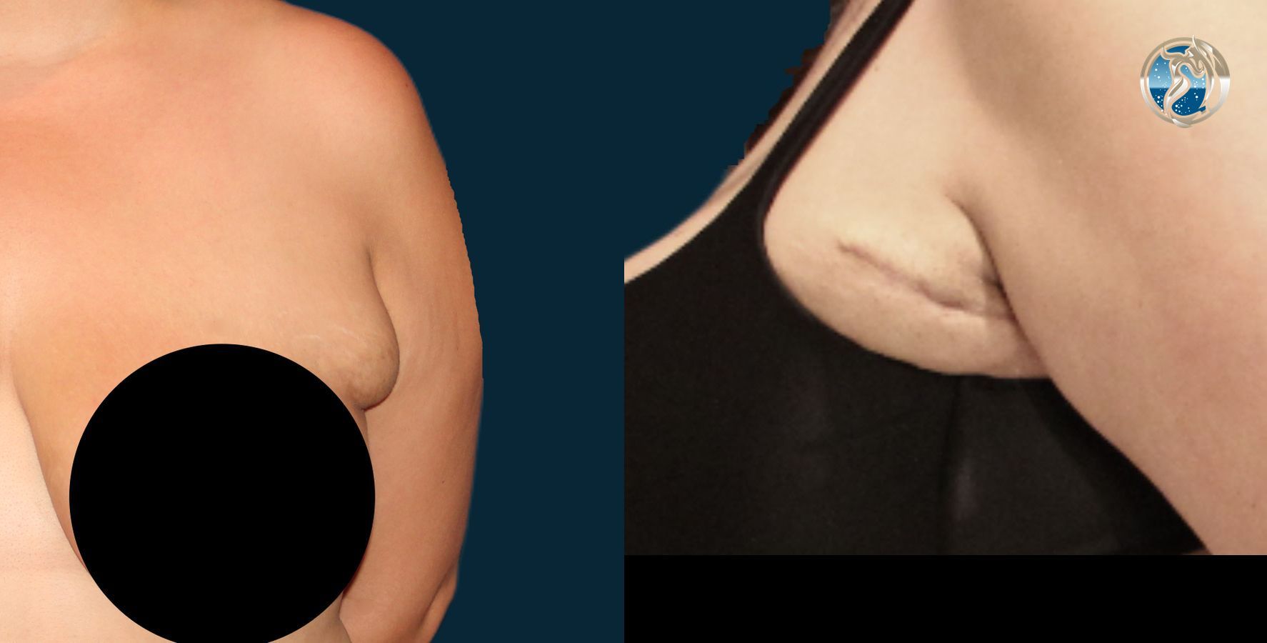 Before and after photo set of Accessory Axillary Breast Tissue Excision by Dr. Orna Fisher in San Mateo, CA - Angle 2