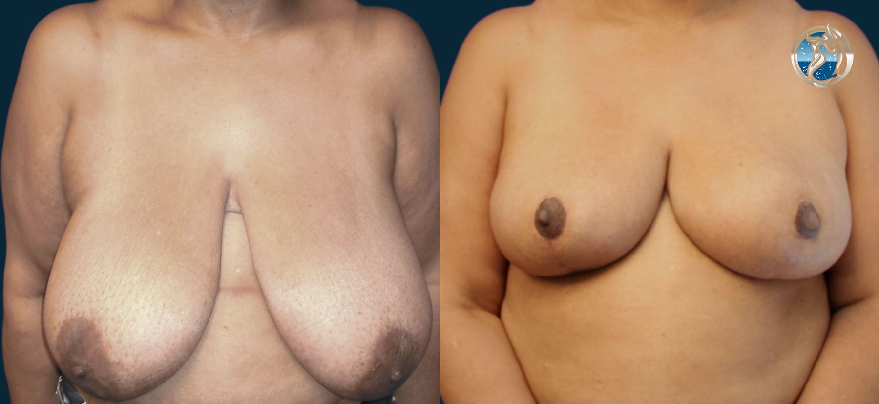 Before and after photo set of Breast Reduction by Dr. Orna Fisher in San Mateo, CA - Angle 3