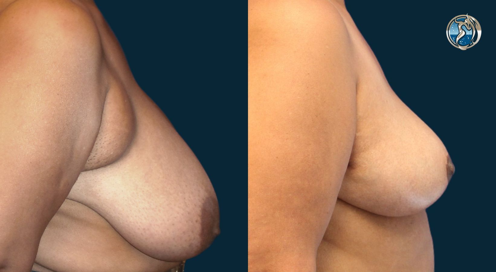Before and after photo set of Breast Reduction by Dr. Orna Fisher in San Mateo, CA - Angle 2