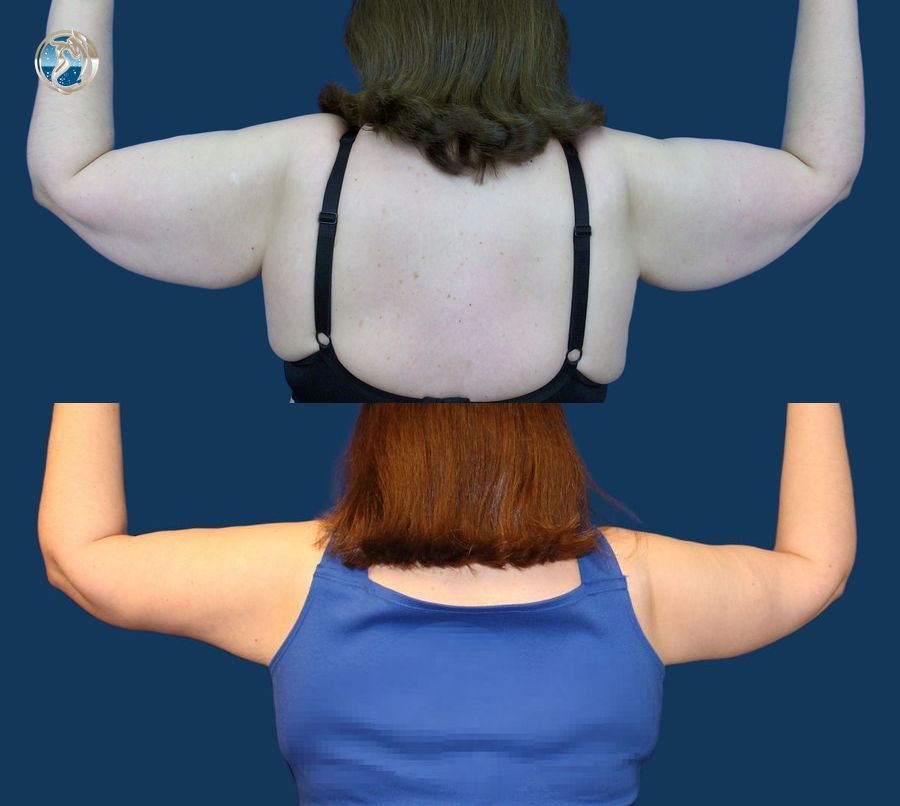 Before and after photo set of body contouring arm lift by Dr. Orna Fisher in San Mateo, CA - Angle 2