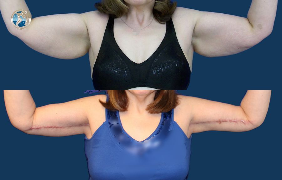 Before and after photo set of body contouring arm lift by Dr. Orna Fisher in San Mateo, CA