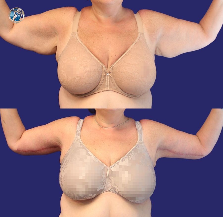 Before and after photo set of body contouring arm lift by Dr. Orna Fisher in San Mateo, CA