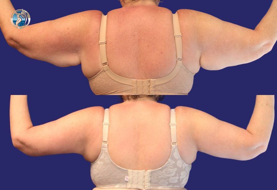 Before and after photo set of body contouring arm lift by Dr. Orna Fisher in San Mateo, CA - Angle 2