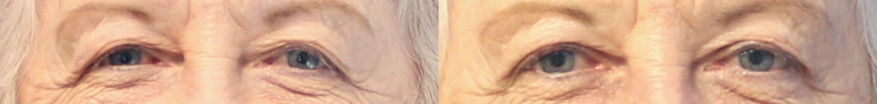 Before and after Blepharoplasty case 46028 - Angle 2