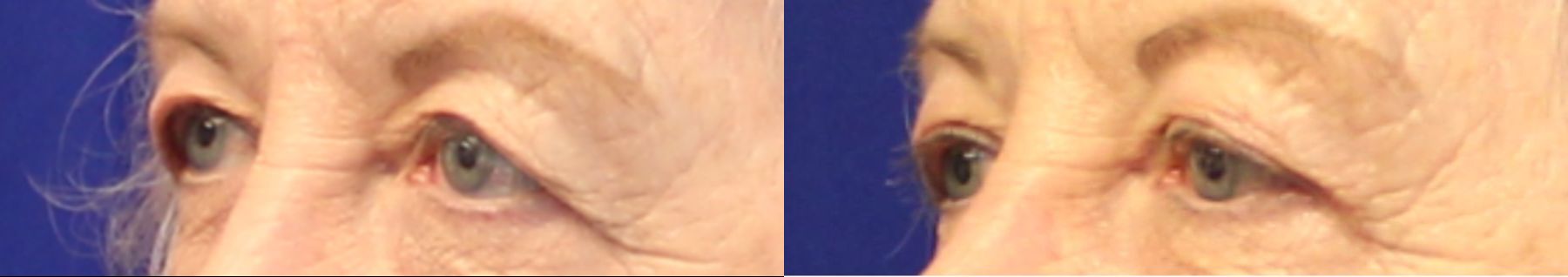 Before and after Blepharoplasty case 46028