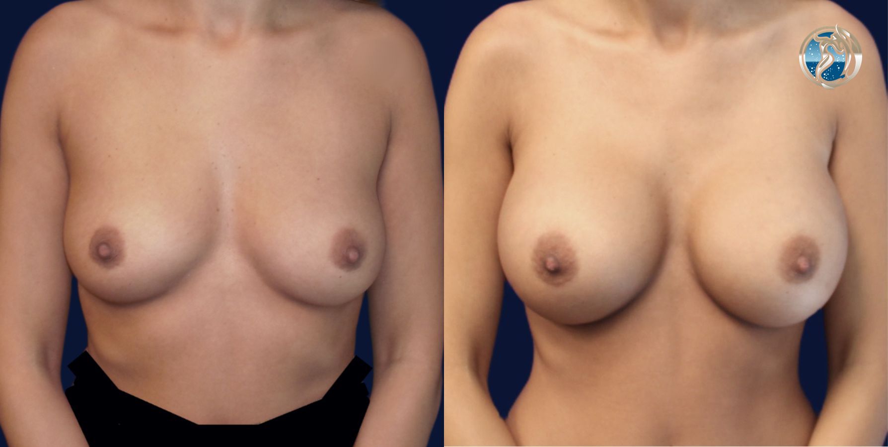 Before and after photo set of breast augmentation by Dr. Orna Fisher in San Mateo, CA