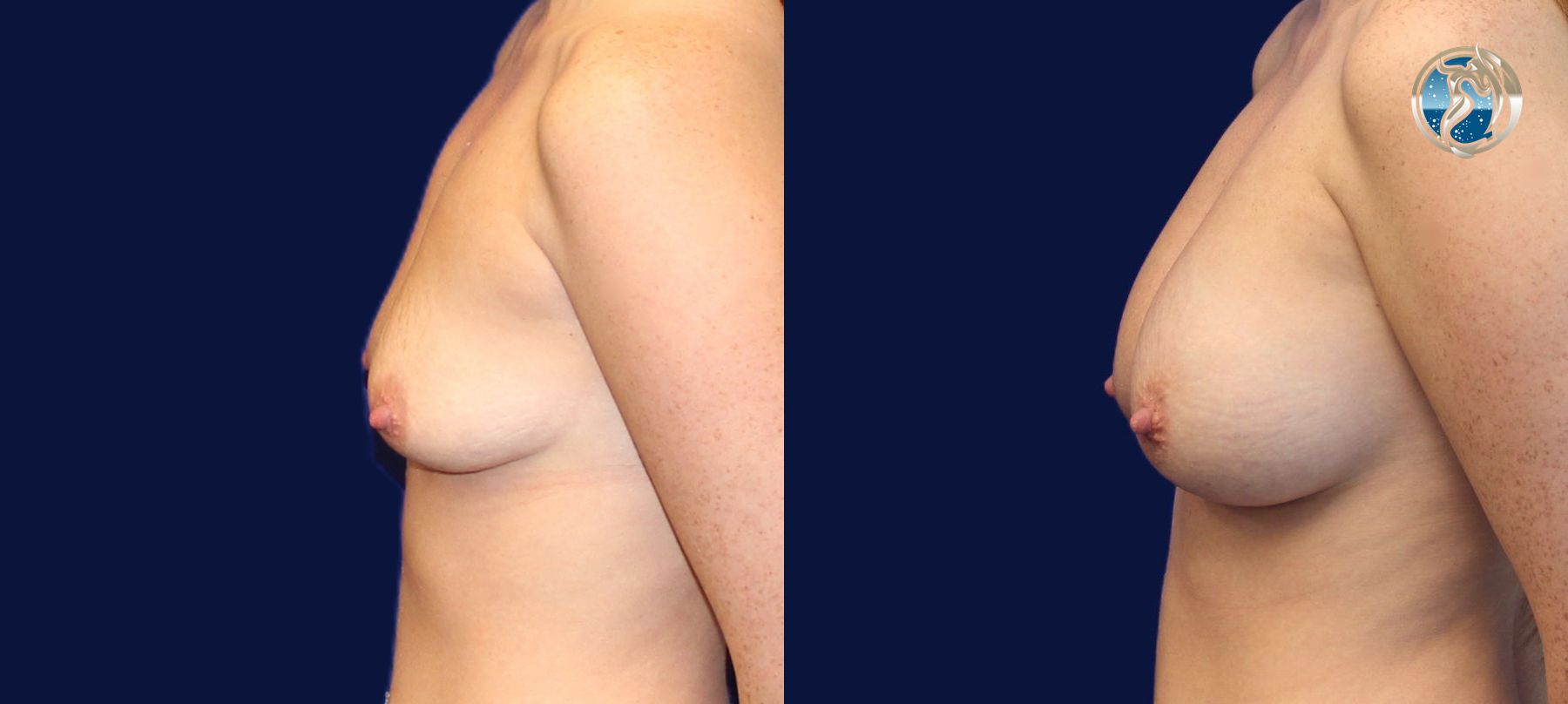 Before and after photo set of breast augmentation by Dr. Orna Fisher in San Mateo, CA - Angle 3