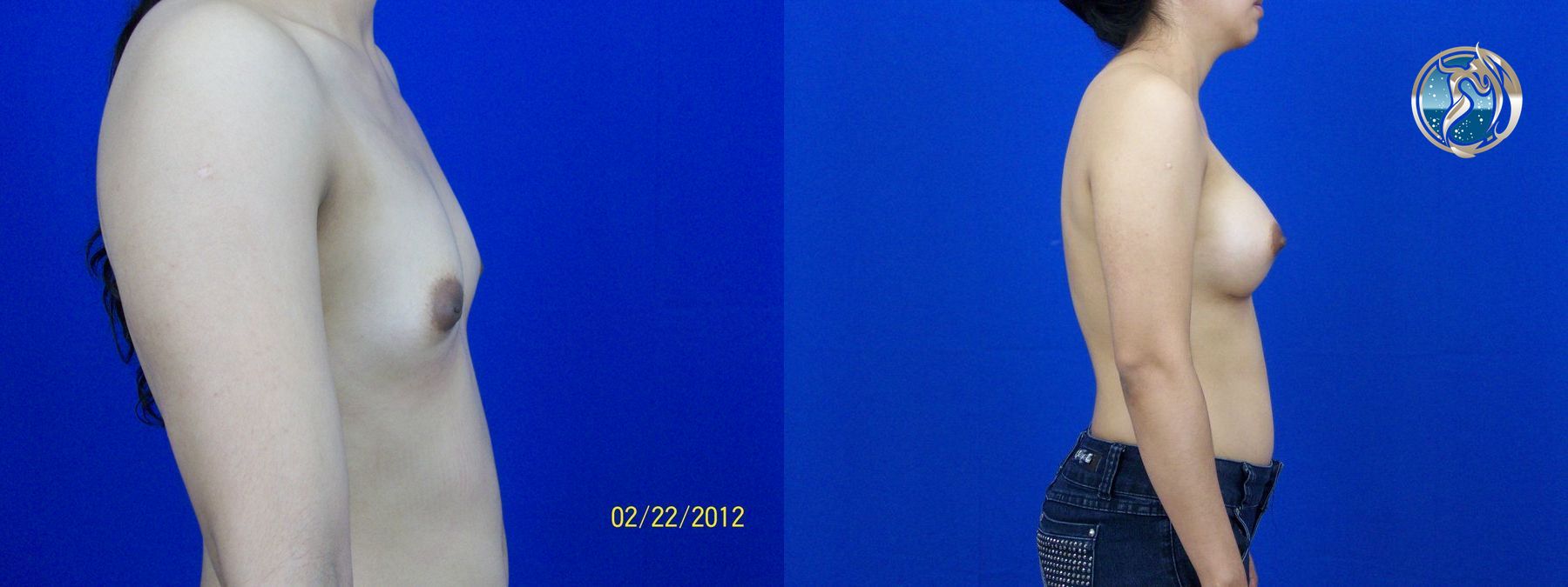 Before and after photo set of breast augmentation by Dr. Orna Fisher in San Mateo, CA - Angle 5