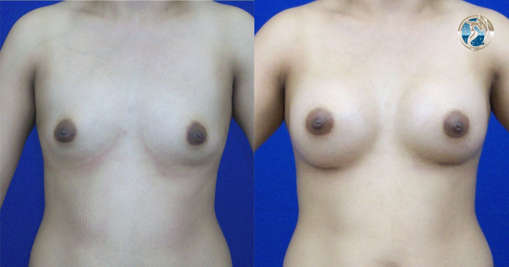 Before and after photo set of breast augmentation by Dr. Orna Fisher in San Mateo, CA