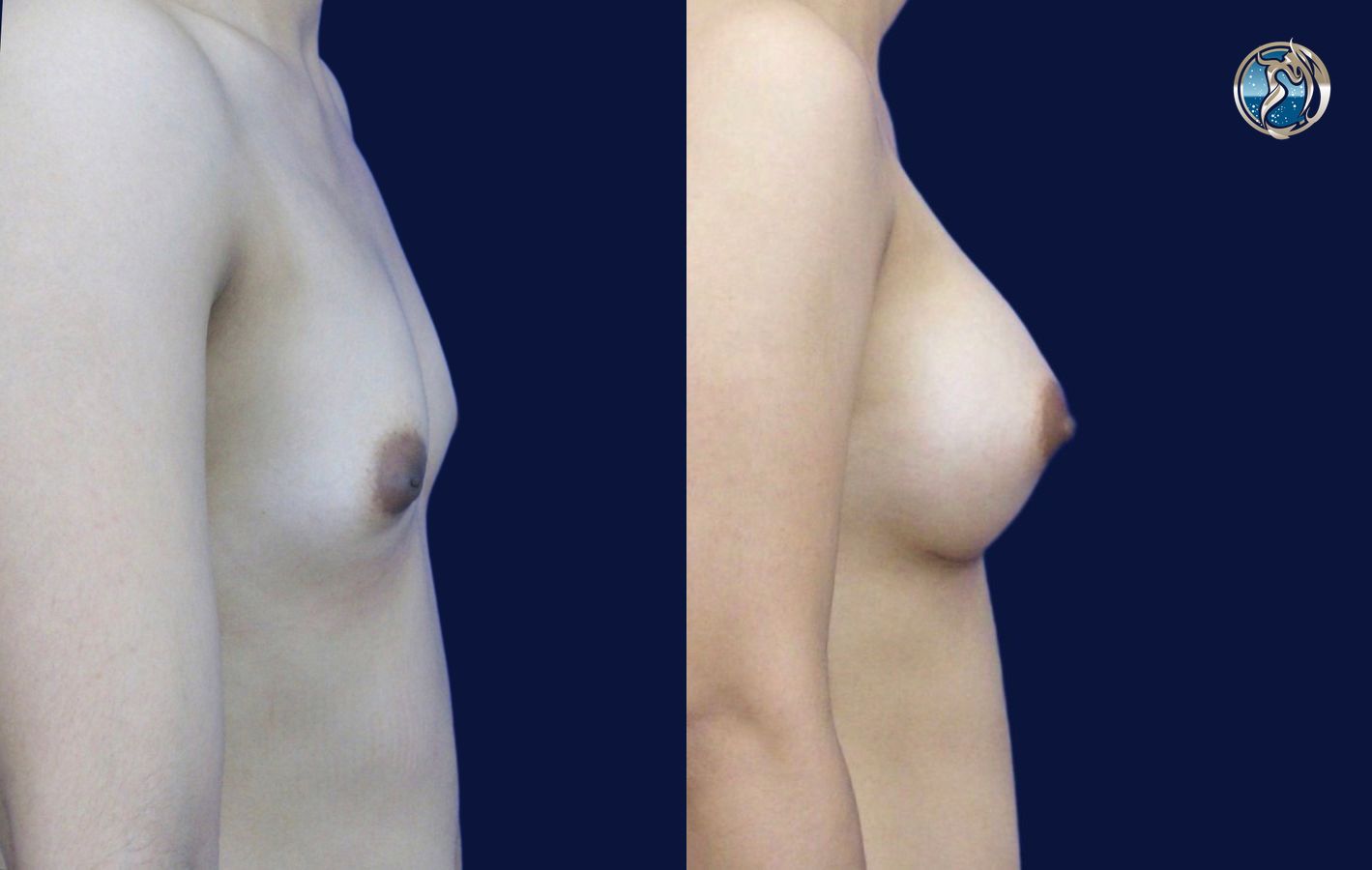 Before and after photo set of breast augmentation by Dr. Orna Fisher in San Mateo, CA - Angle 3