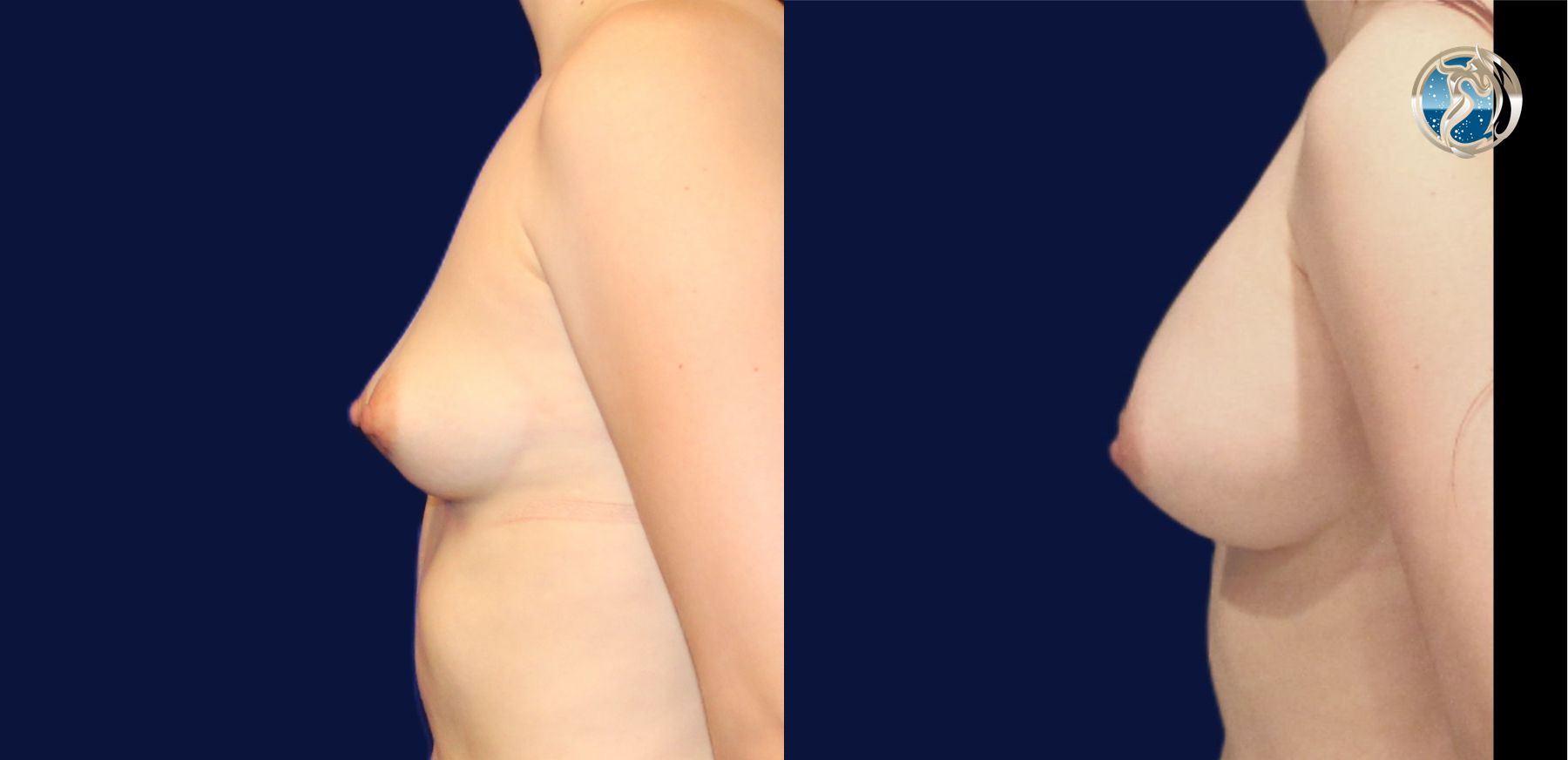Before and after photo set of breast augmentation by Dr. Orna Fisher in San Mateo, CA - Angle 3