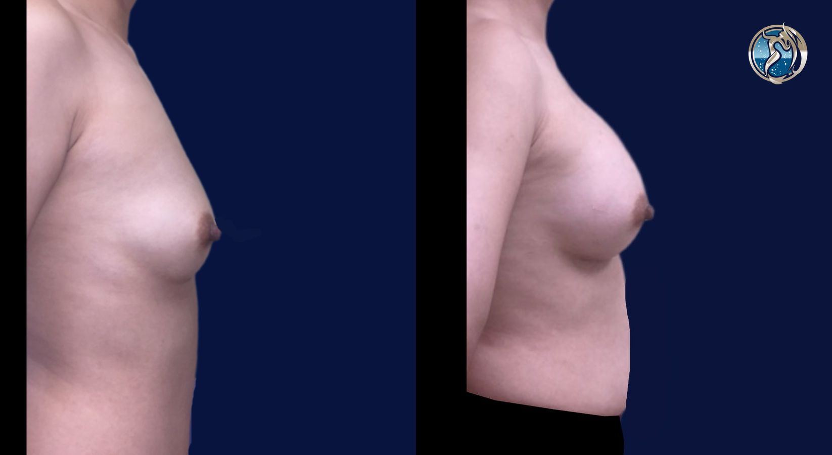 Before and after Breast Augmentation case 46088 - Angle 5