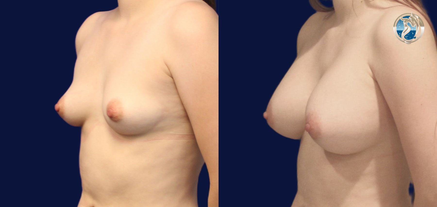 Before and after photo set of breast augmentation by Dr. Orna Fisher in San Mateo, CA - Angle 2