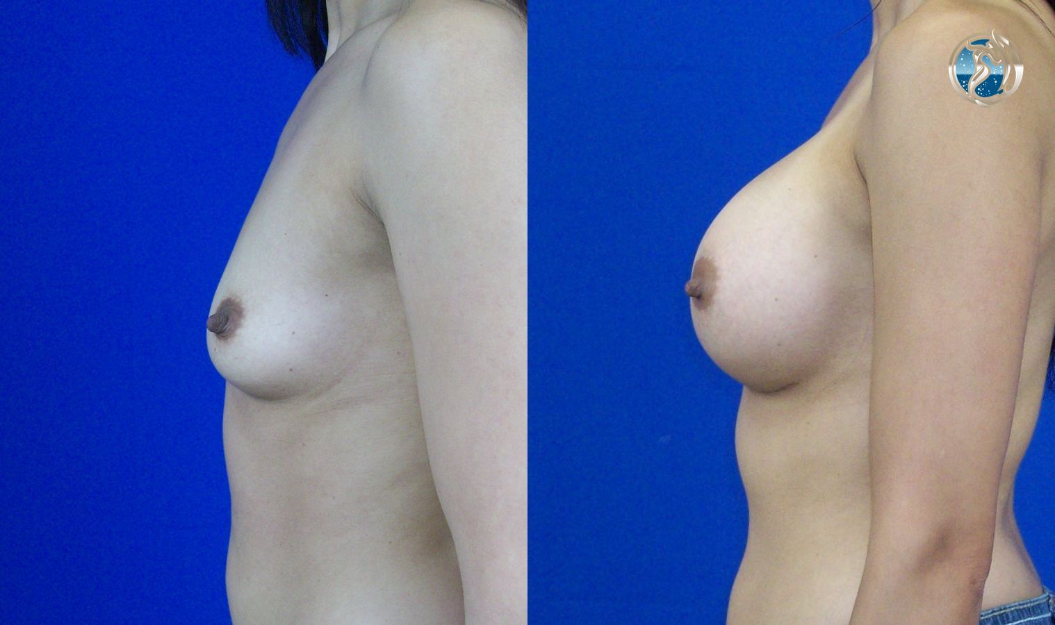 Before and after photo set of breast augmentation by Dr. Orna Fisher in San Mateo, CA - Angle 3
