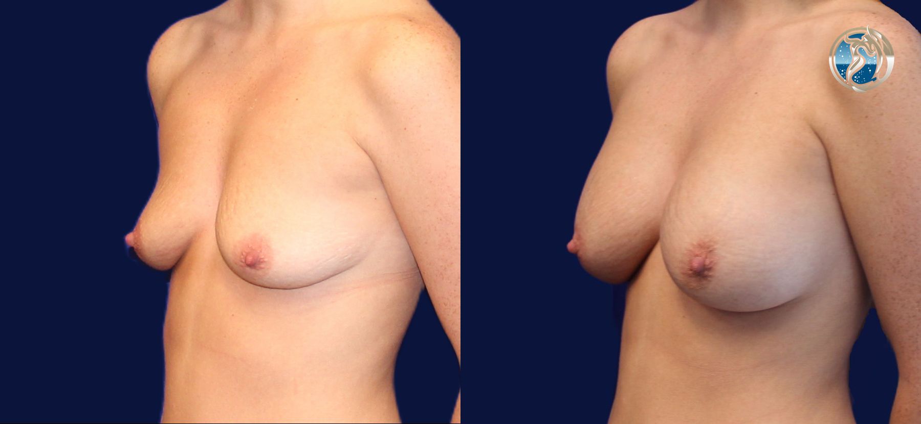 Before and after photo set of breast augmentation by Dr. Orna Fisher in San Mateo, CA - Angle 2