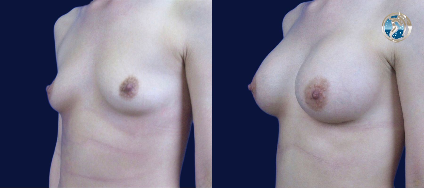 Before and after photo set of breast augmentation by Dr. Orna Fisher in San Mateo, CA - Angle 3