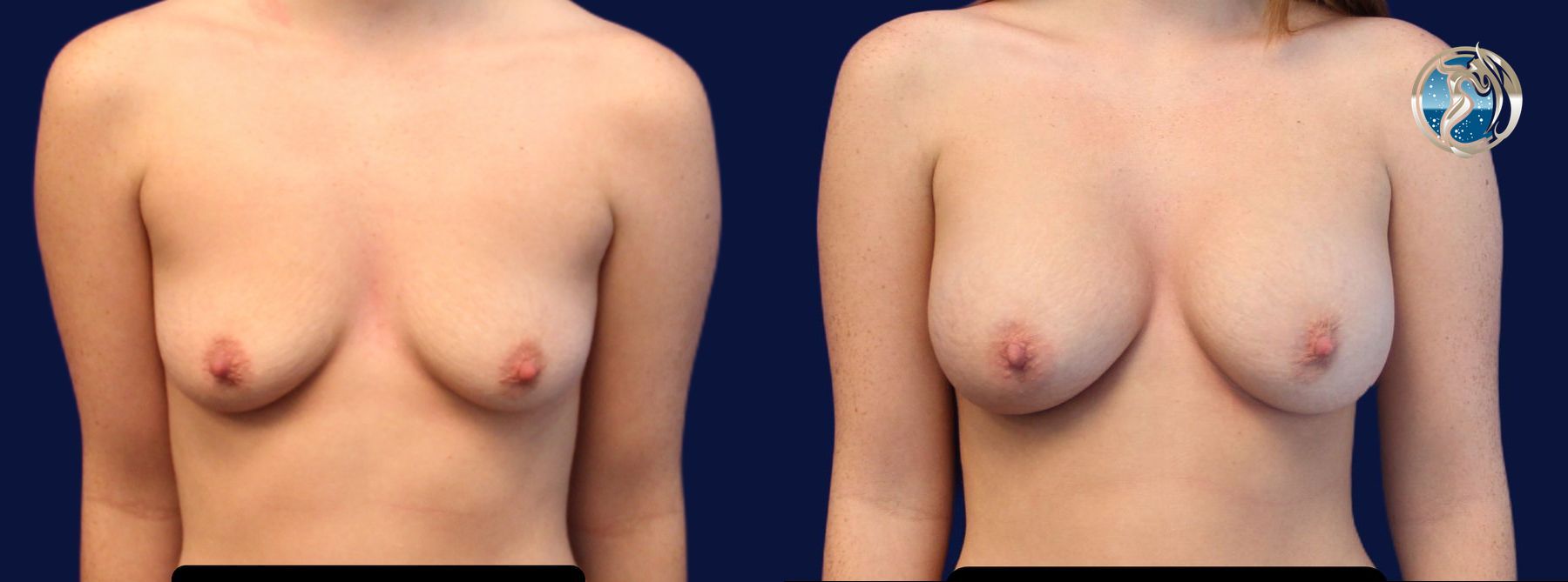 Before and after photo set of breast augmentation by Dr. Orna Fisher in San Mateo, CA