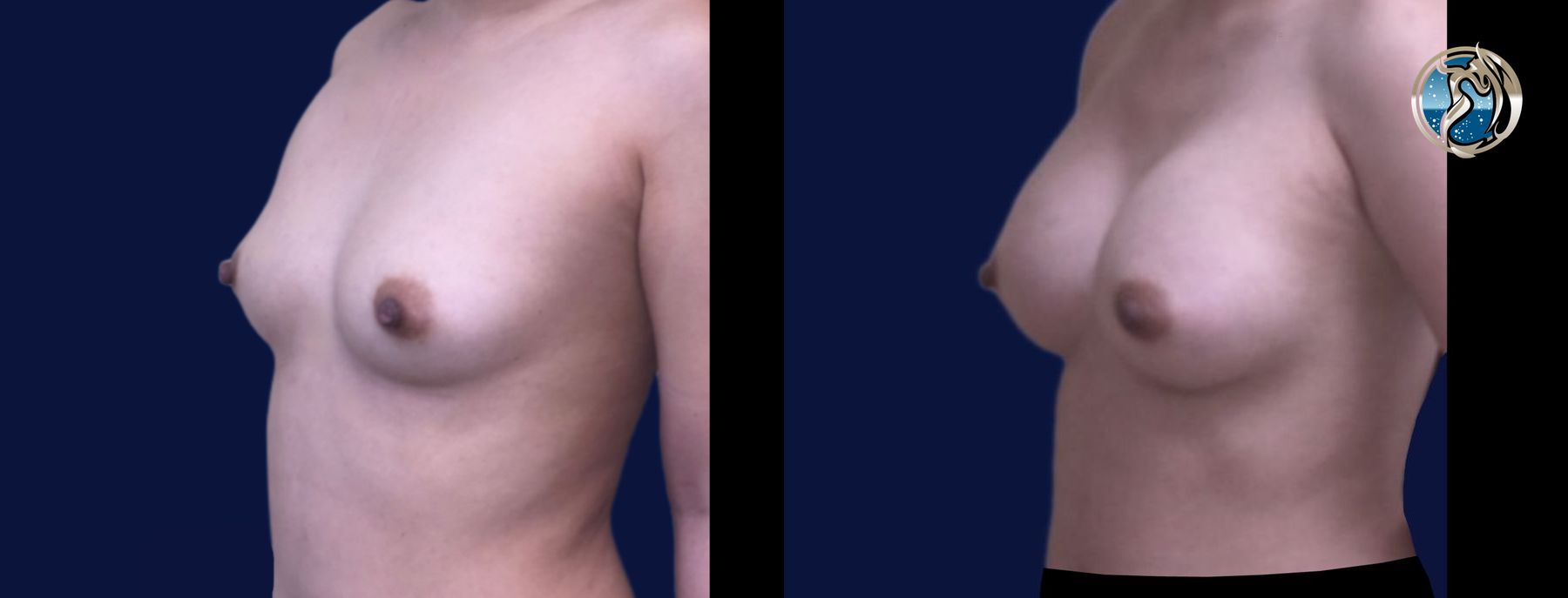 Before and after Breast Augmentation case 46088 - Angle 2