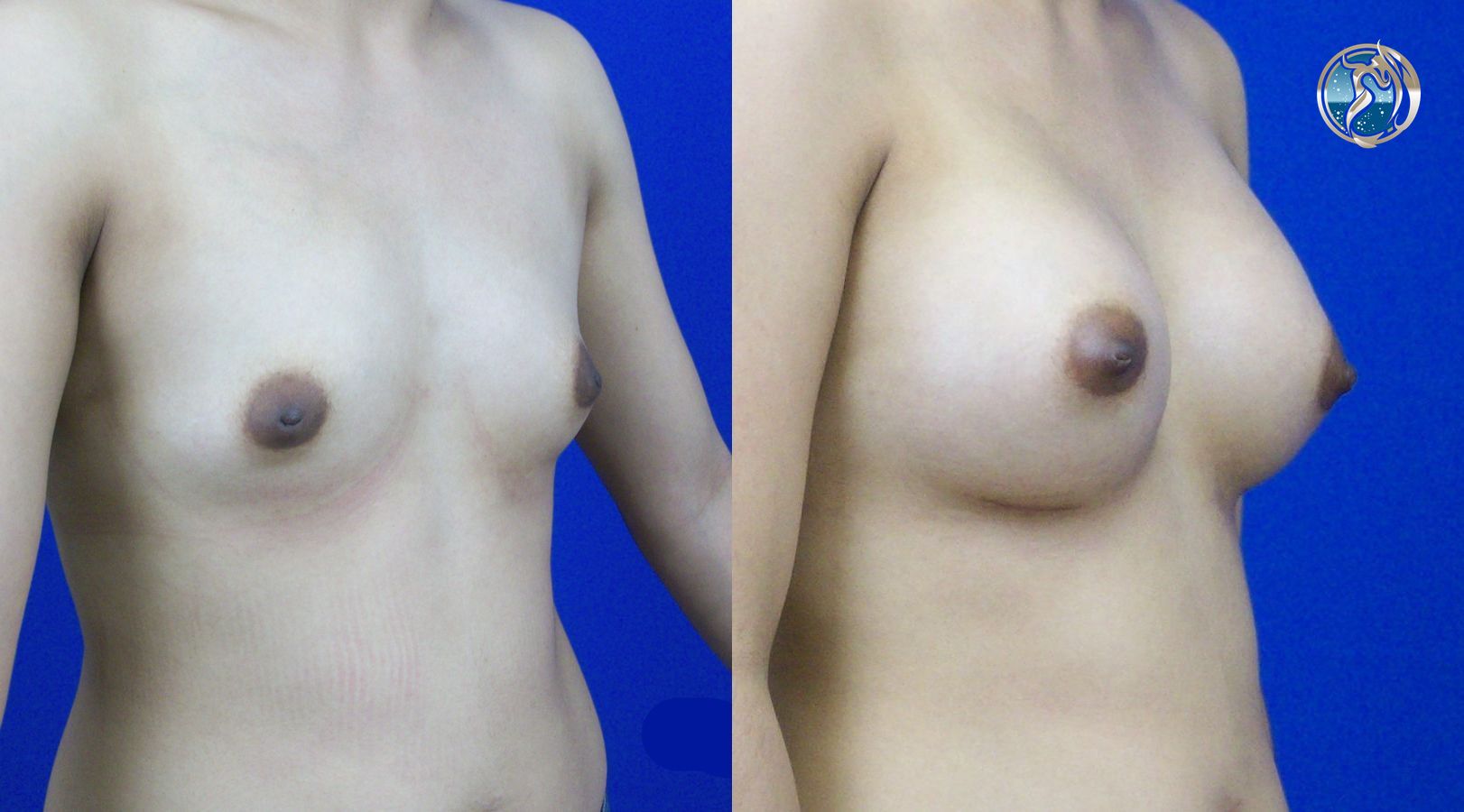 Before and after photo set of breast augmentation by Dr. Orna Fisher in San Mateo, CA - Angle 4