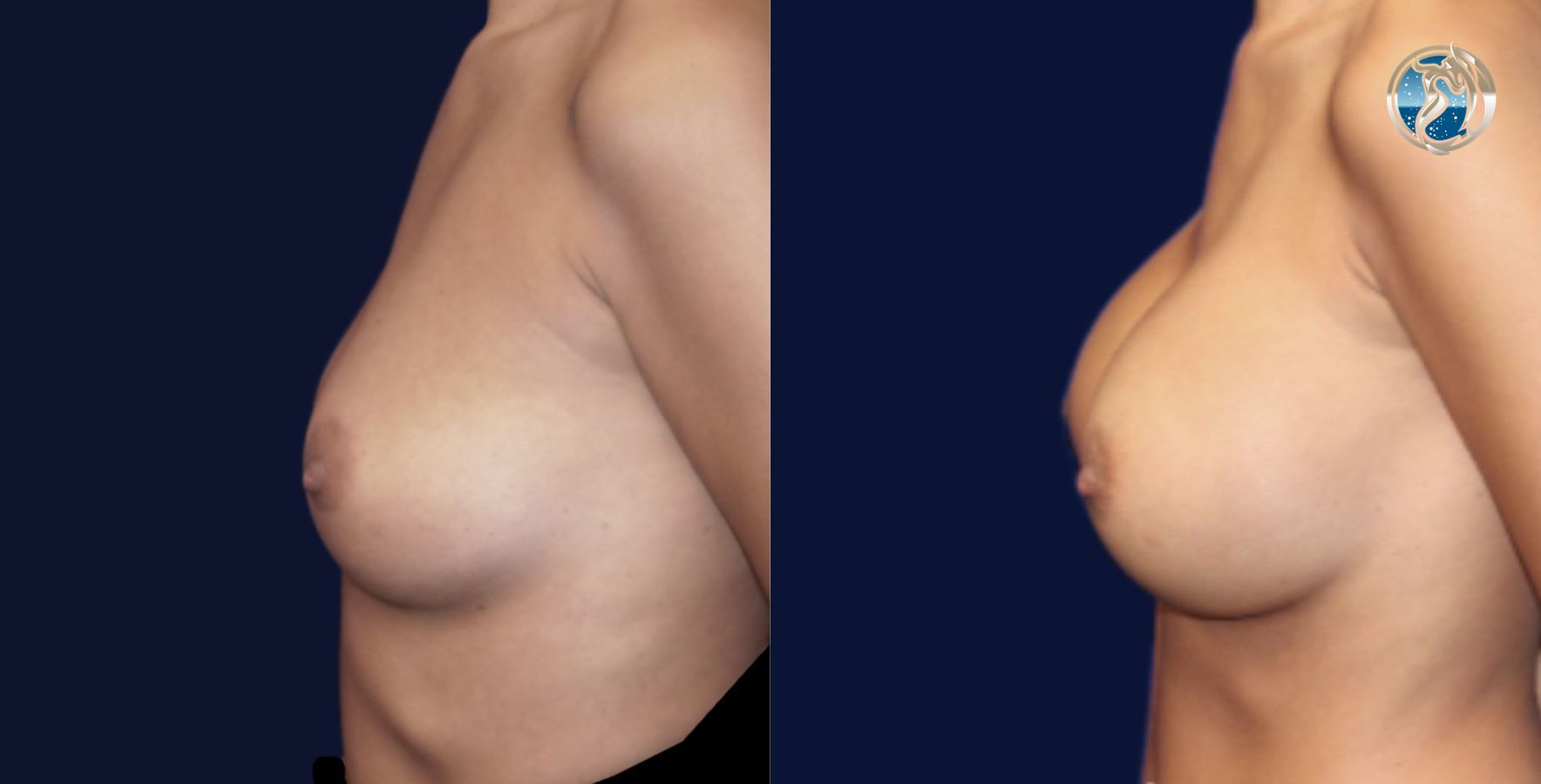 Before and after photo set of breast augmentation by Dr. Orna Fisher in San Mateo, CA - Angle 3