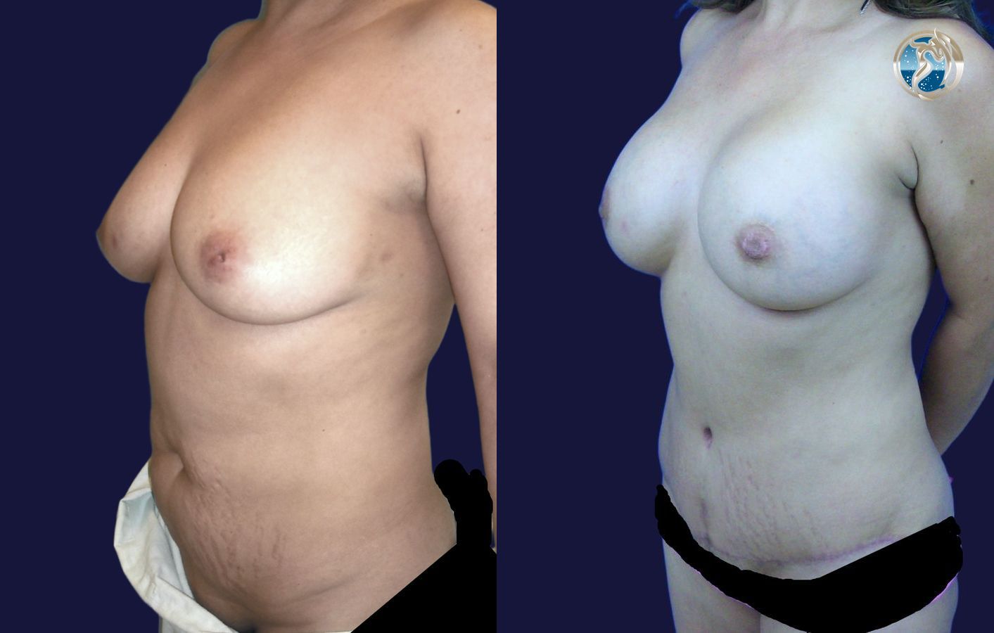 Before and after Combined Abdominal and Breast rejuvenation case 43772 - Angle 4