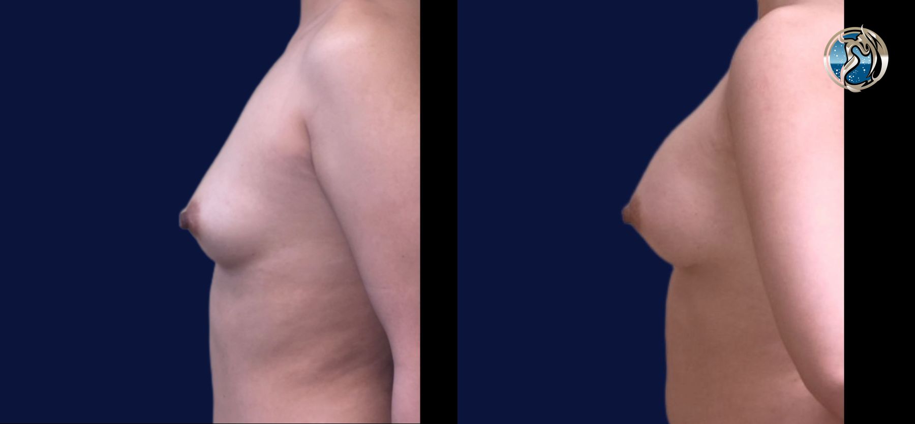 Before and after Breast Augmentation case 46088 - Angle 3