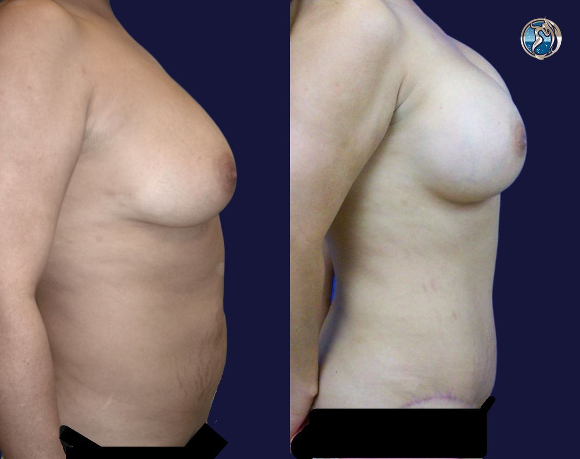 Before and after Combined Abdominal and Breast rejuvenation case 43772 - Angle 3