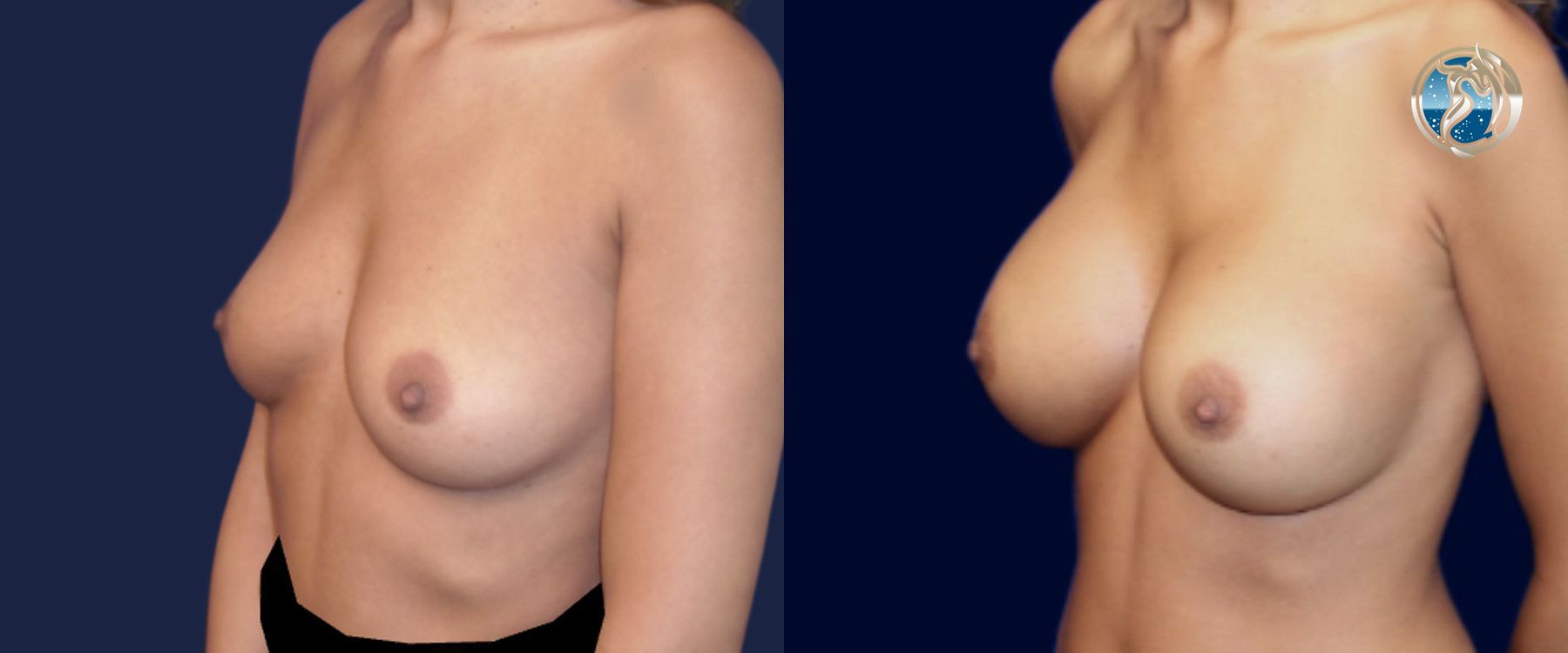 Before and after photo set of breast augmentation by Dr. Orna Fisher in San Mateo, CA - Angle 2