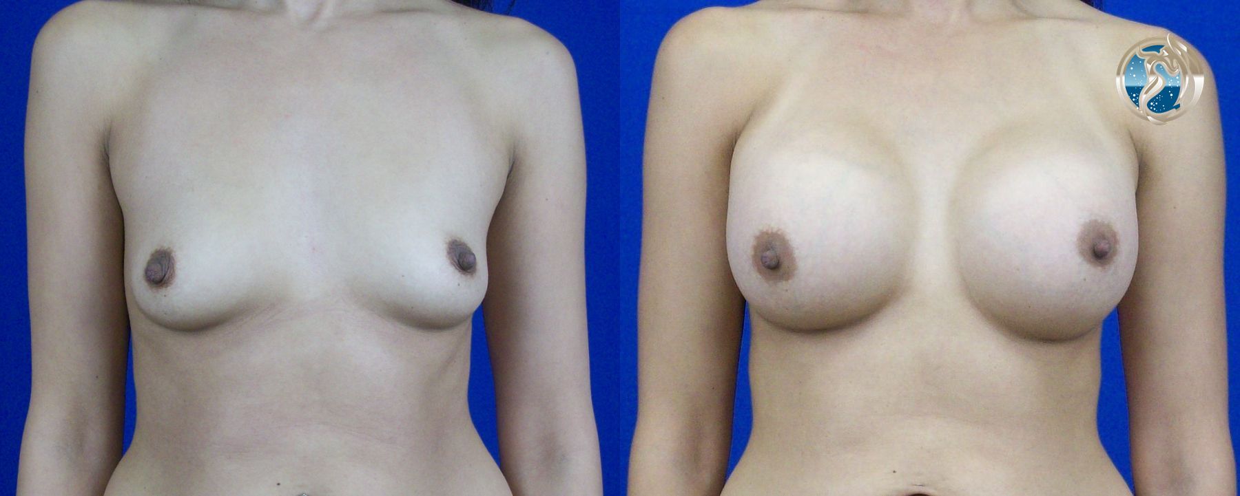 Before and after photo set of breast augmentation by Dr. Orna Fisher in San Mateo, CA