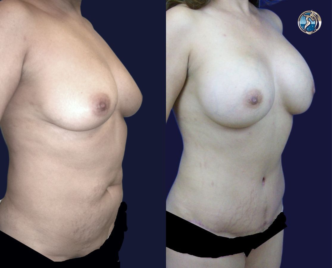 Before and after Combined Abdominal and Breast rejuvenation case 43772 - Angle 2