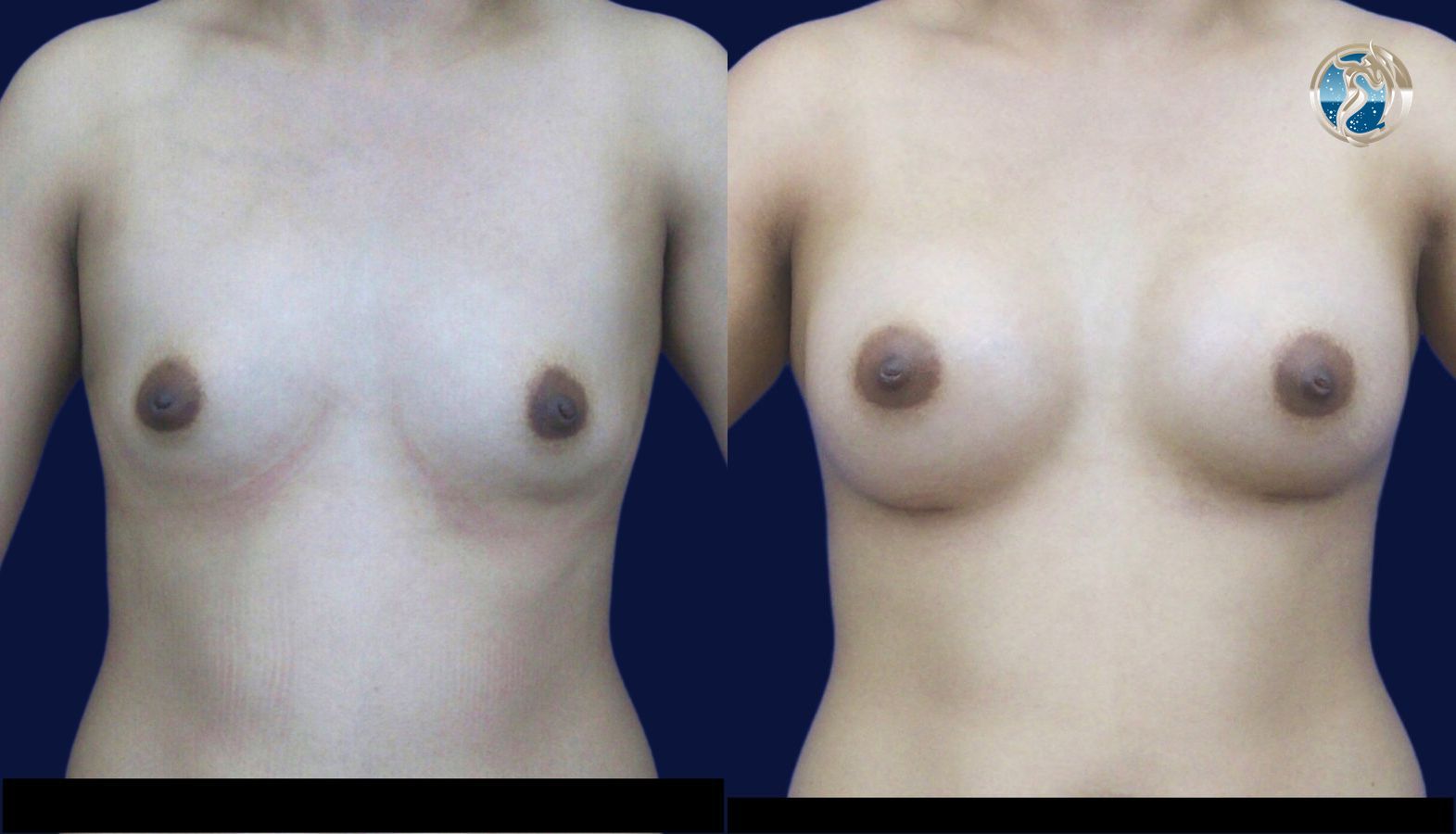 Before and after photo set of breast augmentation by Dr. Orna Fisher in San Mateo, CA