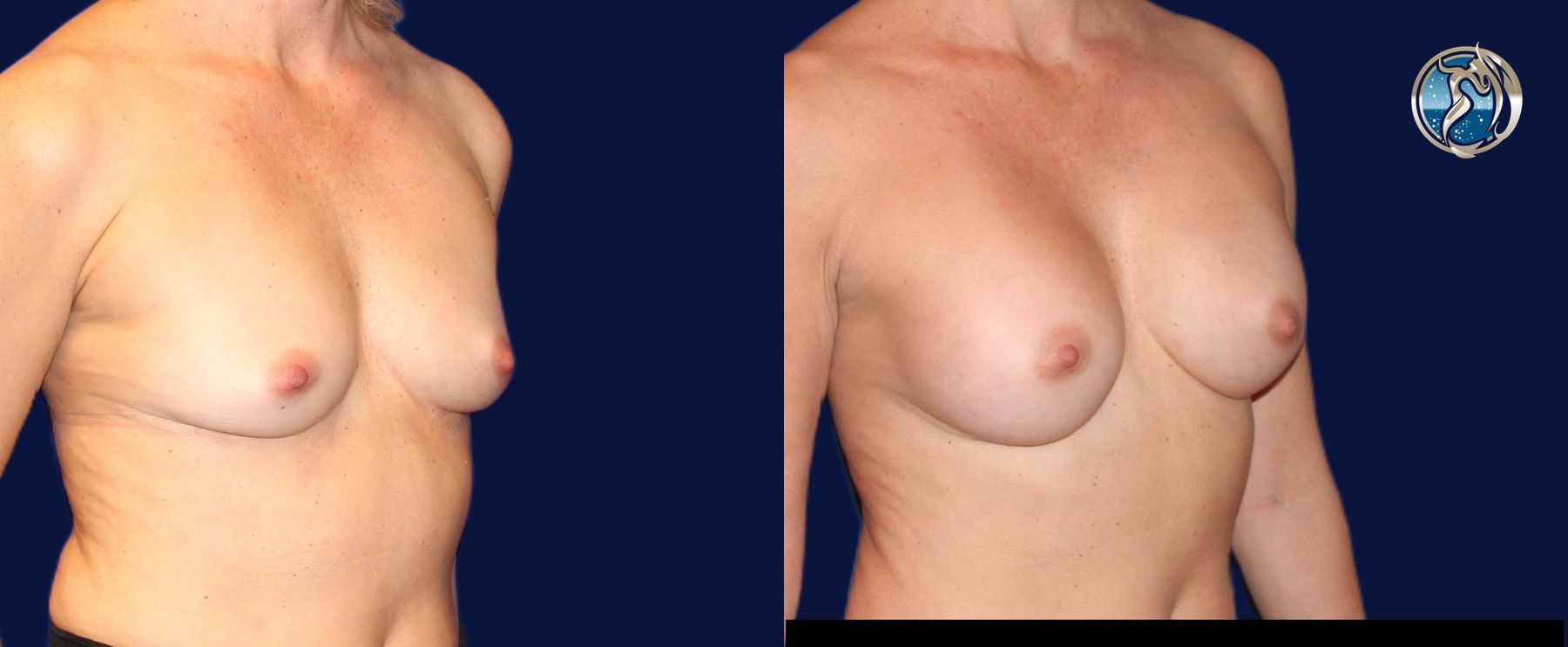 Before and after photo set of breast augmentation by Dr. Orna Fisher in San Mateo, CA - Angle 3