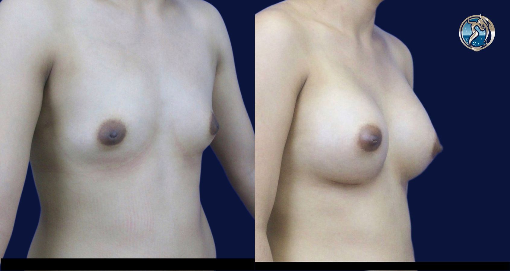 Before and after photo set of breast augmentation by Dr. Orna Fisher in San Mateo, CA - Angle 2