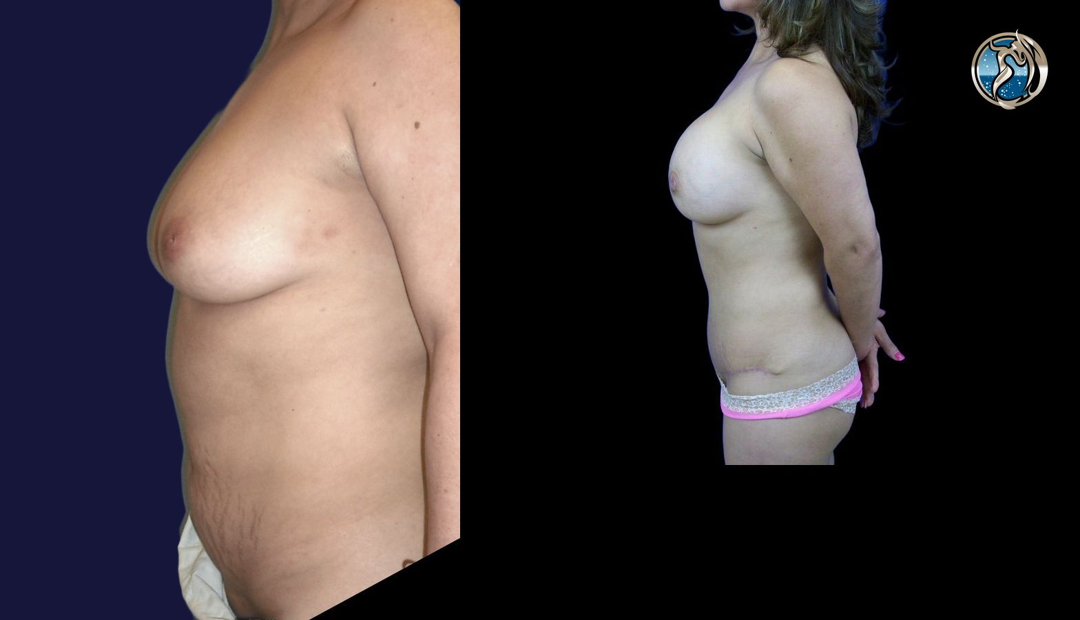 Before and after Combined Abdominal and Breast rejuvenation case 43772 - Angle 5