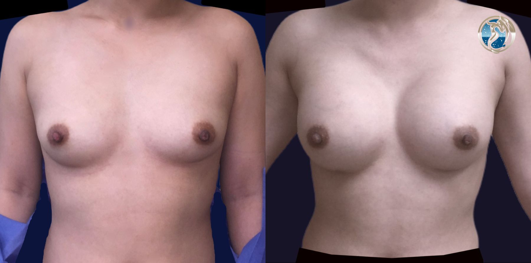 Before and after Breast Augmentation case 46088